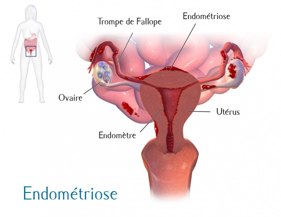 Endom&eacute;trisose - Les sympt&ocirc;mes
